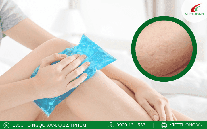 Dùng đá lạnh chườm lên vết cắn của kiến lửa