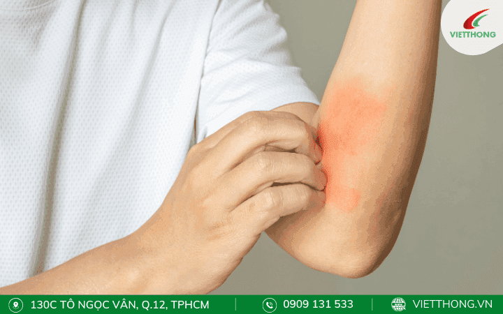 Không gãi khi bị kiến lửa cắn