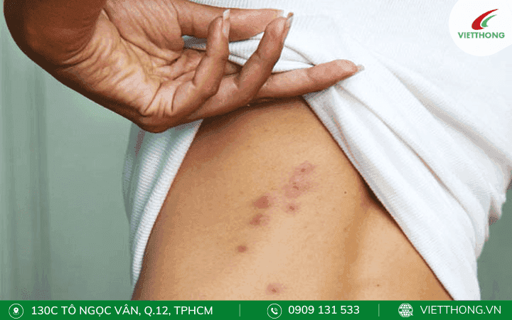 Các triệu chứng khi bị rết cắn