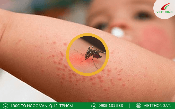 Sốt xuất huyết Sốt xuất huyết