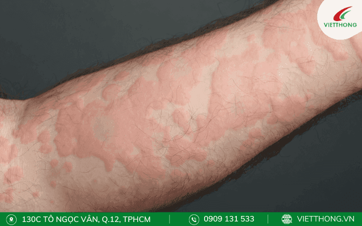 Theo dõi các phản ứng dị ứng