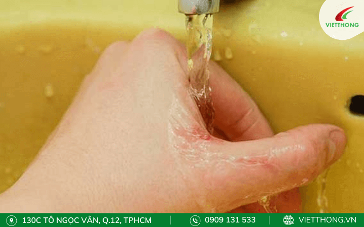 Cần nhanh chóng rửa sạch khi bị kiến ba khoang cắn