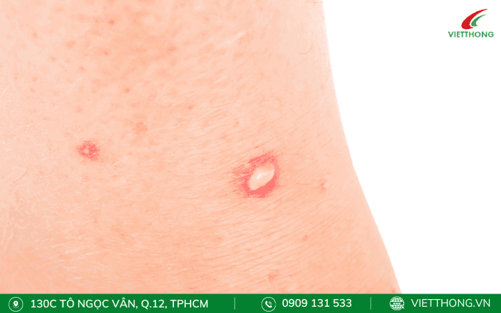 Vết kiến đốt làm mủ Vết kiến đốt làm mủ